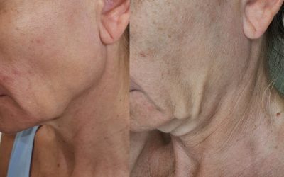 HIFU – pogromca drugiego podbródka i „chomików”