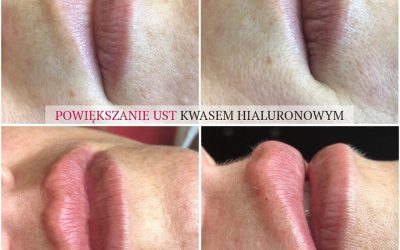 Powiększanie ust