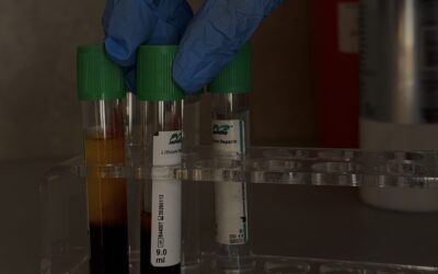 Osocze i fibryna bogatopłytkowa – efekty, które widać.