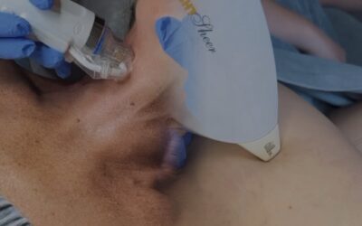 Ostatni moment na zabiegi laserowe i radiofrekwencję mikroigłową