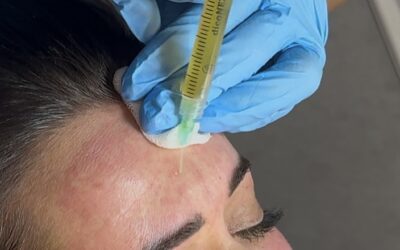 Nowoczesna regeneracja skóry: Zestaw Potrójnej Regeneracji z Osoczem i Fibryną